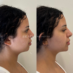 Expert Dermal Chin Filler Injection, Williamstown