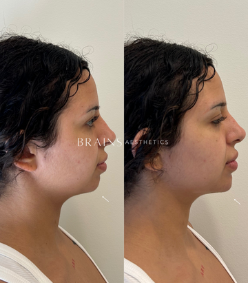 Expert Dermal Chin Filler Injection, Williamstown