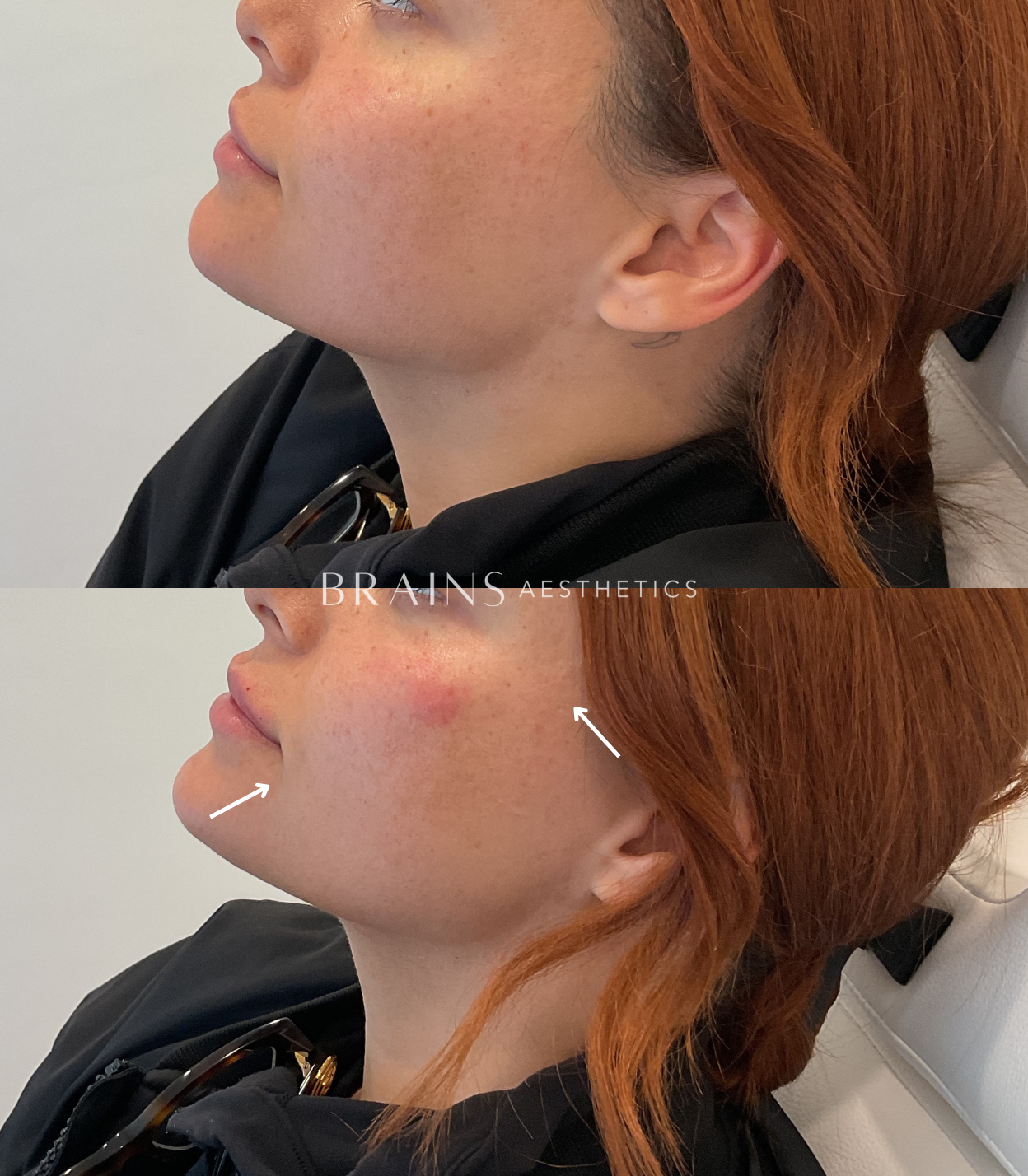 Anti-wrinkle, Dermal Fillers, Lip Fillers, Plump Lips, Rejuran, Skin Booster, Bio-remodelling. Experienced cosmetic injector in Melbourne West, Williamstown, Newport, Altona, Williamstown North.