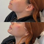 Anti-wrinkle, Dermal Fillers, Lip Fillers, Plump Lips, Rejuran, Skin Booster, Bio-remodelling. Experienced cosmetic injector in Melbourne West, Williamstown, Newport, Altona, Williamstown North.