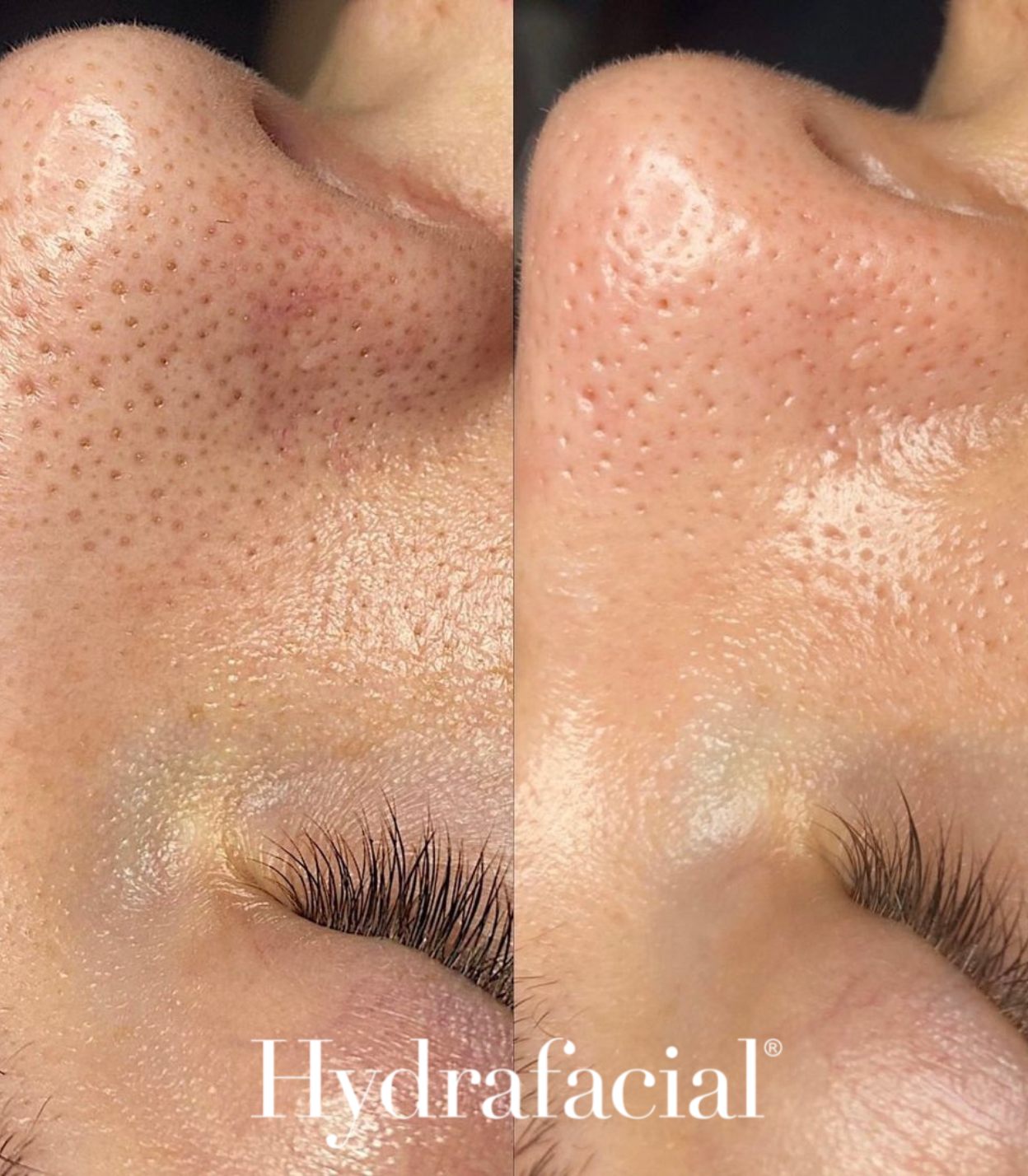 HydraFacial - Clear Blackheads - Brains Aesthetics Williamstown