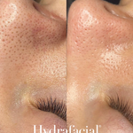 HydraFacial - Clear Blackheads - Brains Aesthetics Williamstown