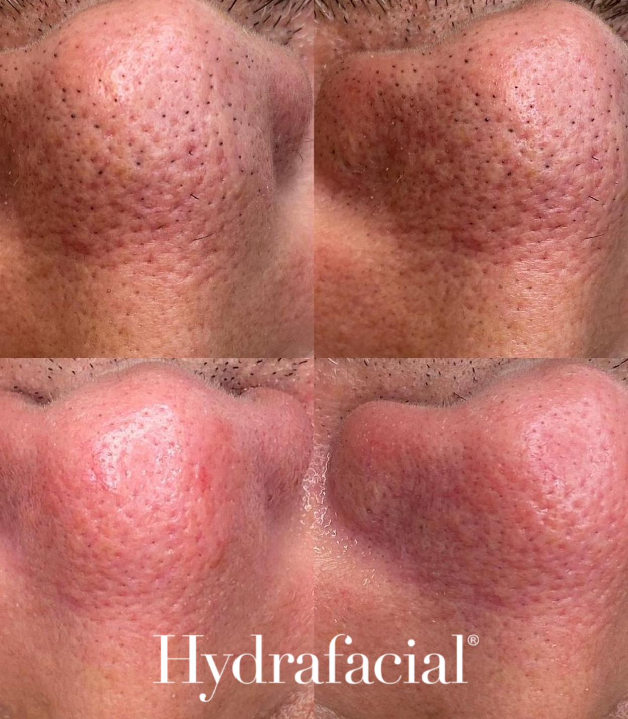 HydraFacial - Clear Pore Congestion - Brains Aesthetics Williamstown