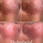 HydraFacial - Clear Pore Congestion - Brains Aesthetics Williamstown
