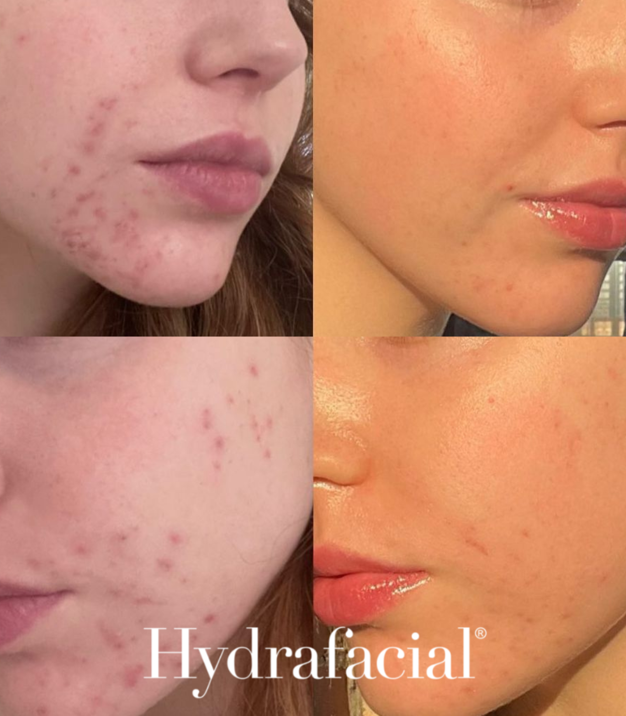 HydraFacial - Improve Acne - Brains Aesthetics Williamstown