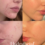 HydraFacial - Improve Acne - Brains Aesthetics Williamstown