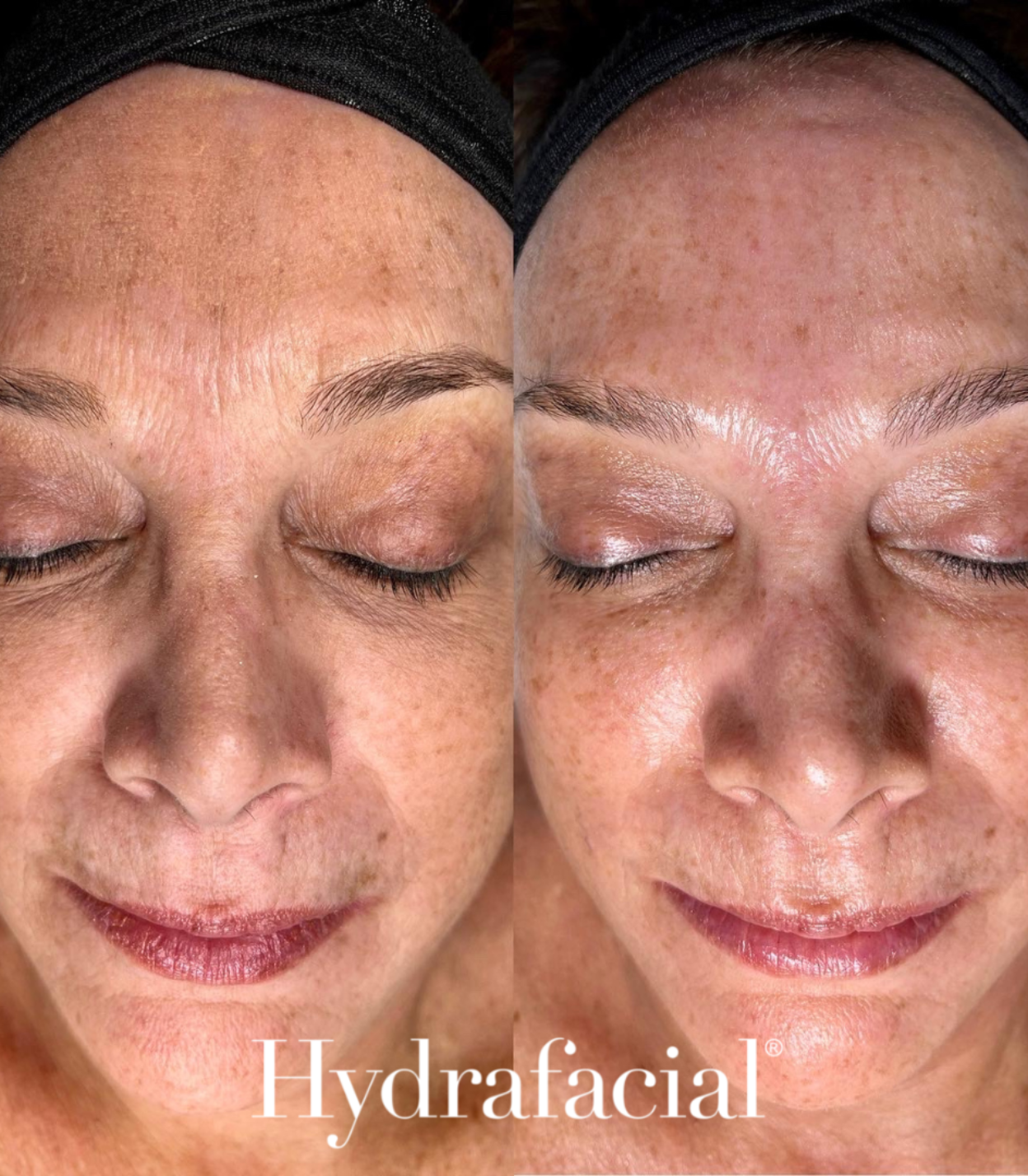 HydraFacial - Improve Lines and Wrinkles, Plump Skin - Brains Aesthetics Williamstown