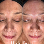HydraFacial - Improve Lines and Wrinkles, Plump Skin - Brains Aesthetics Williamstown