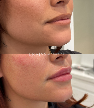 Anti-wrinkle, Dermal Fillers, Lip Fillers, Plump Lips, Rejuran, Skin Booster, Bio-remodelling. Experienced cosmetic injector in Melbourne West, Williamstown, Newport, Altona, Williamstown North