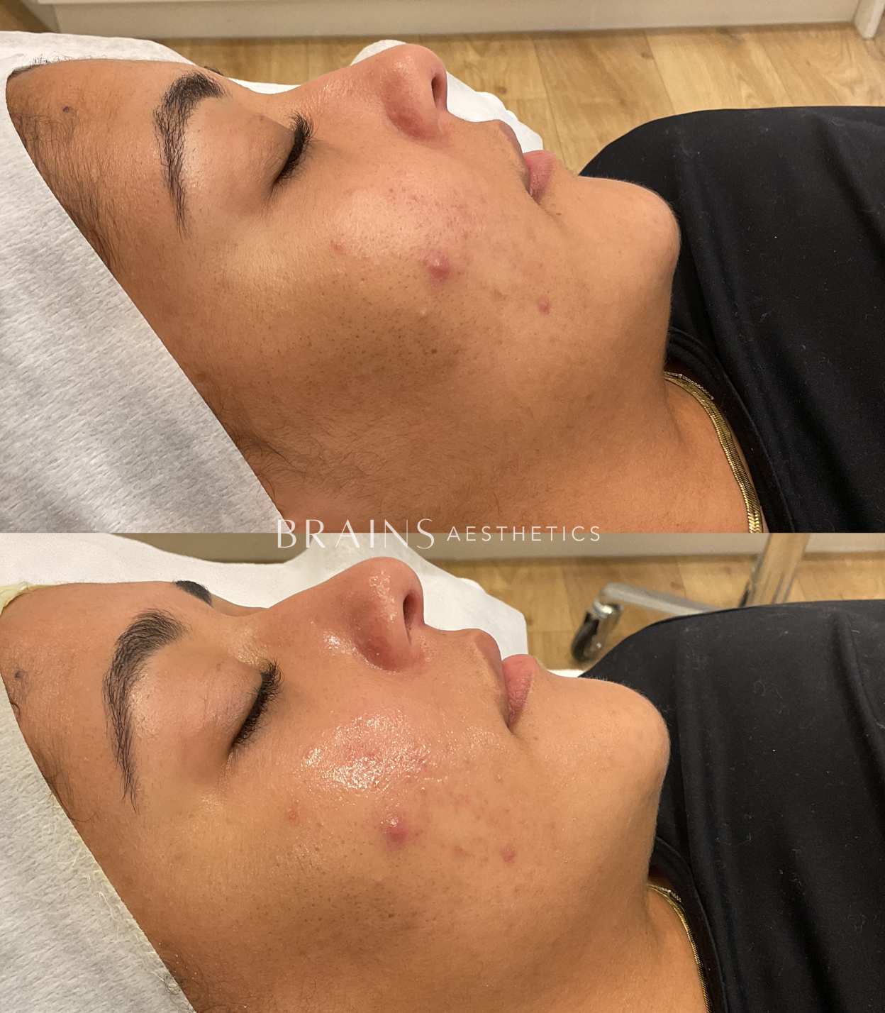 Salicylic Acid Peel by Dermal Clinician Melbourne