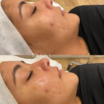 Salicylic Acid Peel by Dermal Clinician Melbourne