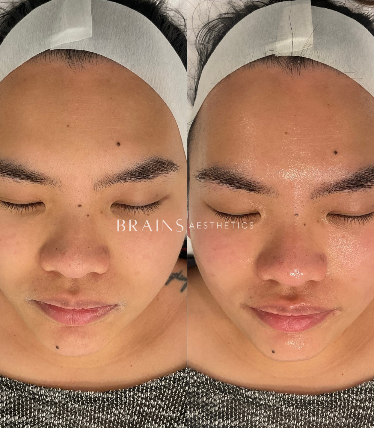 Mandelic Acid Peel by Dermal Clinician Melbourne