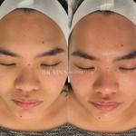 Mandelic Acid Peel by Dermal Clinician Melbourne
