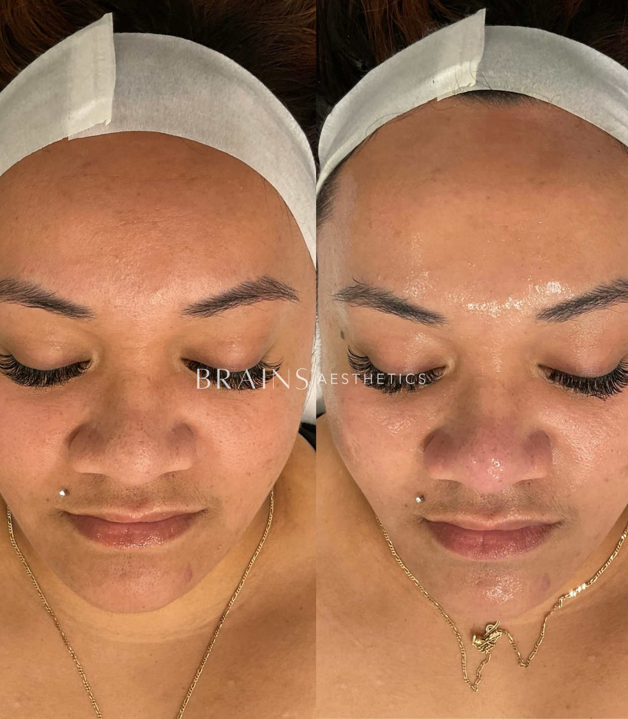 Milk Peel by Dermal Clinician Melbourne