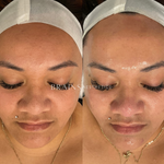 Milk Peel by Dermal Clinician Melbourne