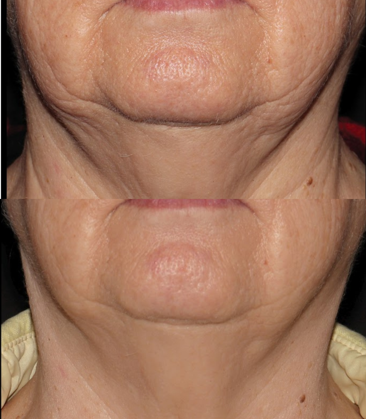 Best Clinic, Defined Jawline, Sofwave Melbourne