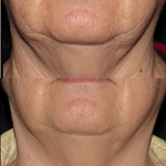 Best Clinic, Defined Jawline, Sofwave Melbourne