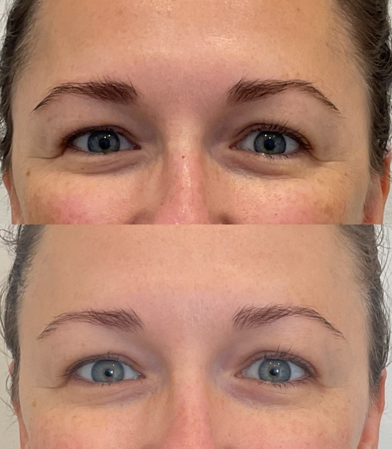 Sofwave skin tightening before and after results at Brains Aesthetics, showing lifted and firmer skin