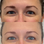 Sofwave skin tightening before and after results at Brains Aesthetics, showing lifted and firmer skin