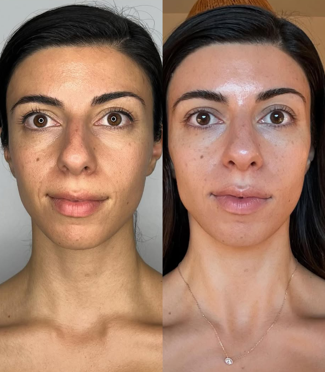 Best Clinic, Skin Lift, Skin Tightening, Sofwave Melbourne