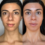 Best Clinic, Skin Lift, Skin Tightening, Sofwave Melbourne