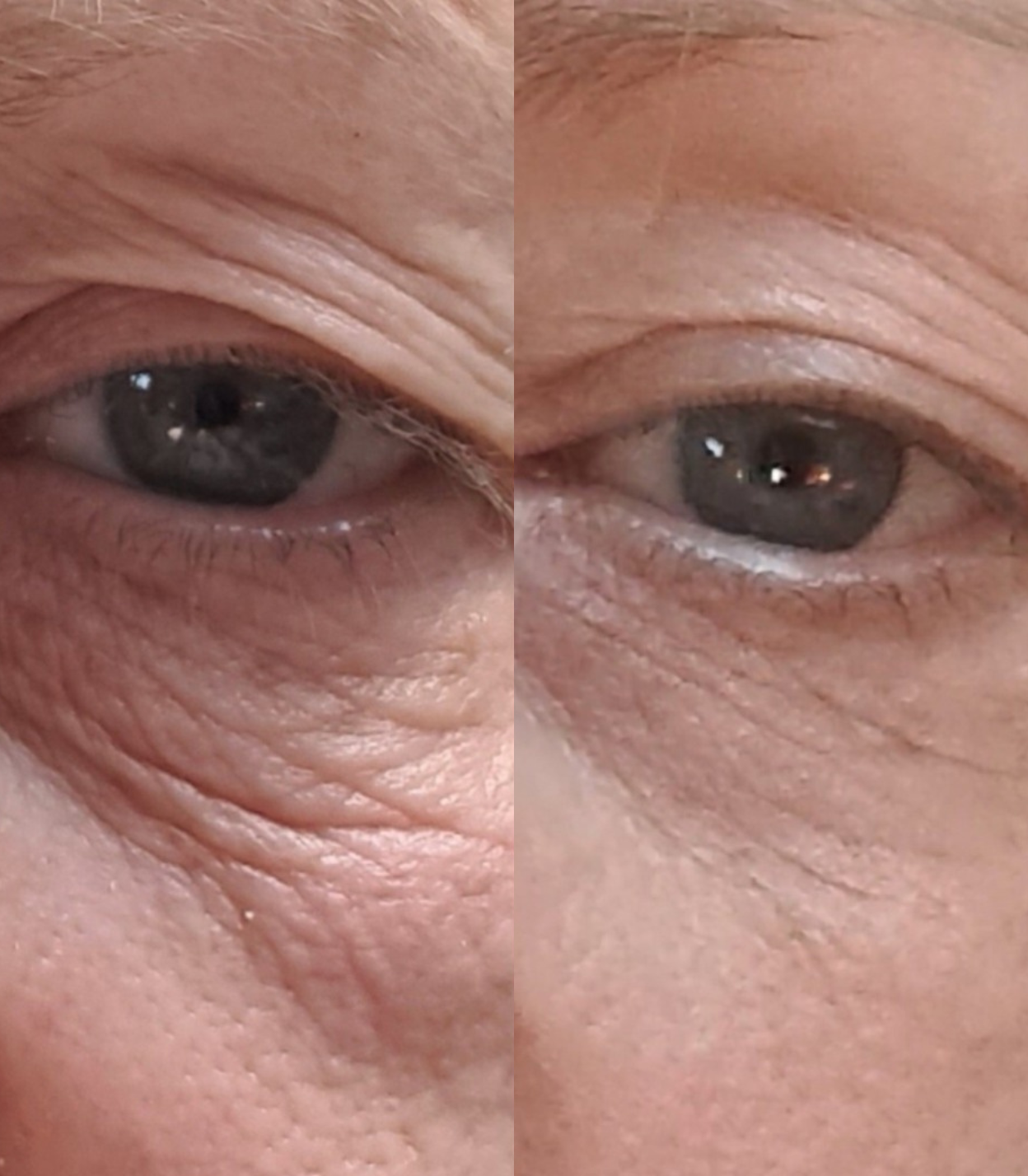 Best Clinic, Eye & Brow Lift, Sofwave Melbourne