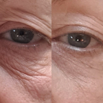 Best Clinic, Eye & Brow Lift, Sofwave Melbourne