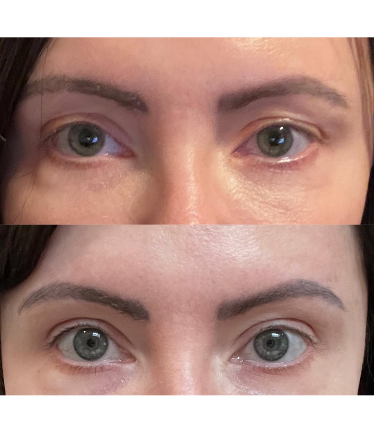 Best Clinic, Eye & Brow Lift, Sofwave Melbourne