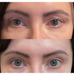 Best Clinic, Eye & Brow Lift, Sofwave Melbourne