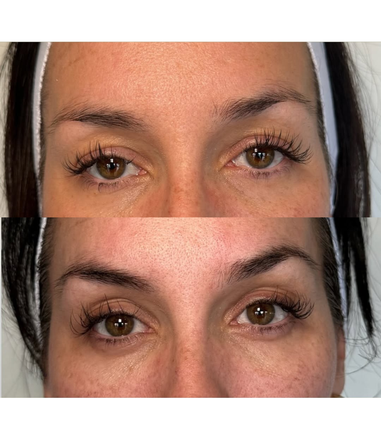 Best Clinic, Eye & Brow Lift, Sofwave Melbourne