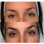 Best Clinic, Eye & Brow Lift, Sofwave Melbourne