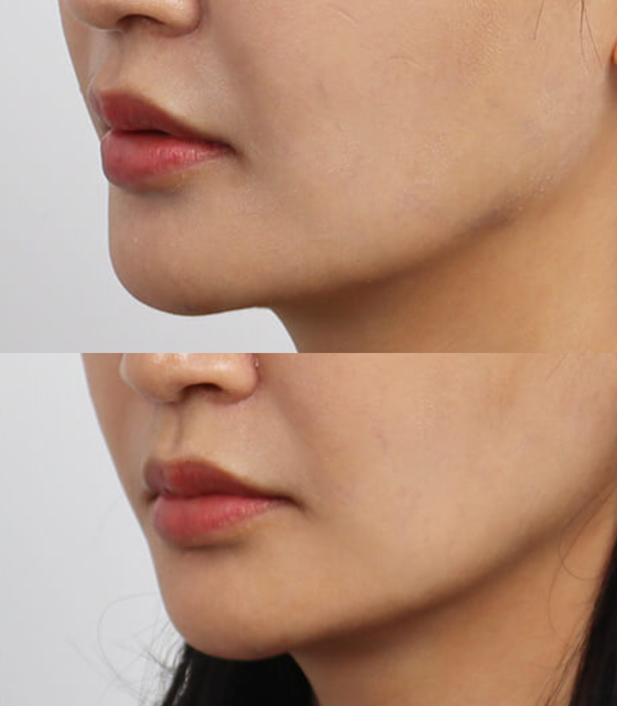 Best Clinic, Defined Jawline, Sofwave Melbourne