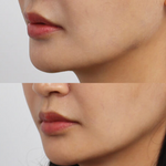 Best Clinic, Defined Jawline, Sofwave Melbourne