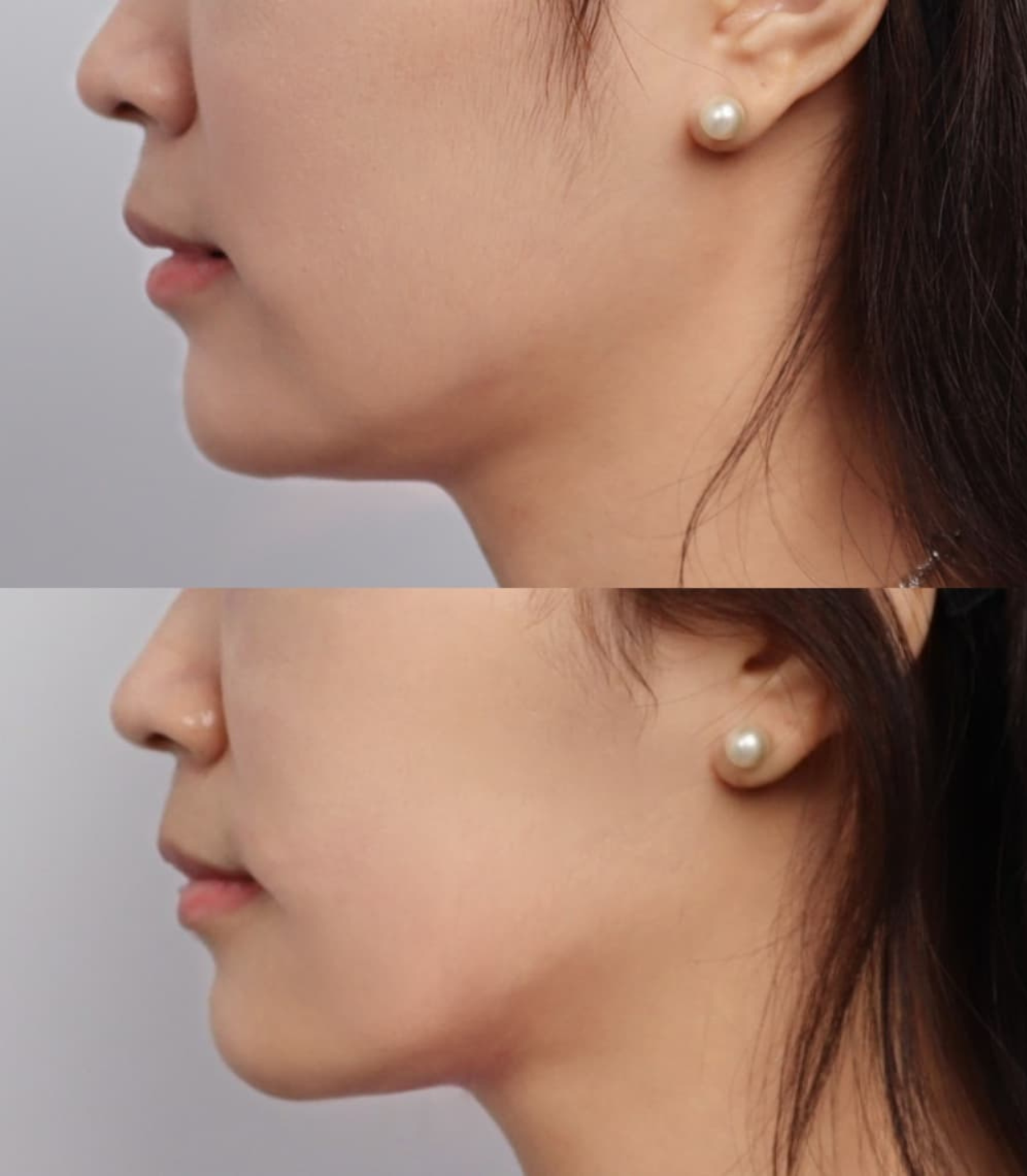 Best Clinic, Defined Jawline, Sofwave Melbourne