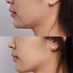 Best Clinic, Defined Jawline, Sofwave Melbourne
