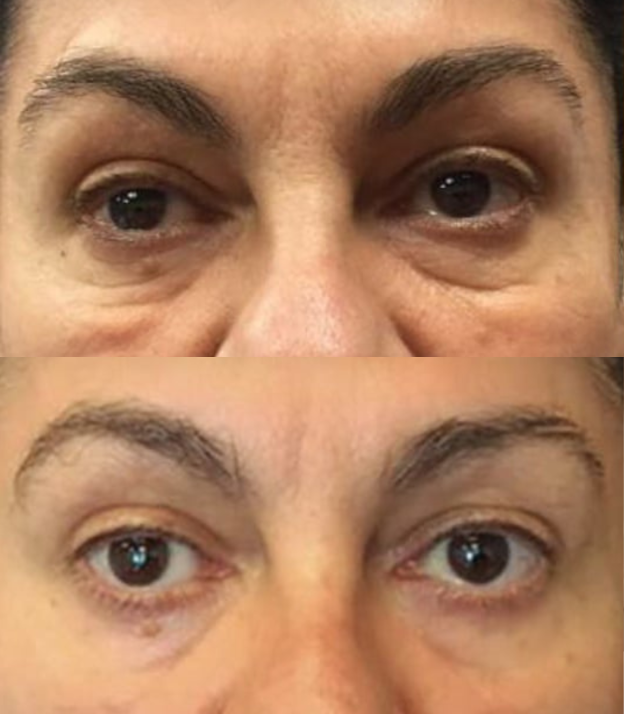 Best Clinic, Eye & Brow Lift, Sofwave Melbourne