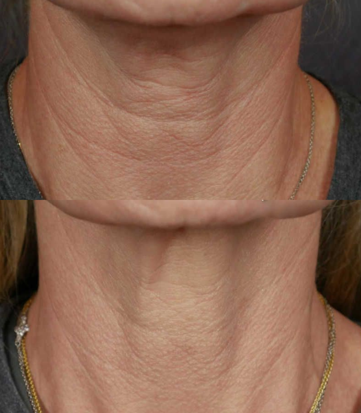 Best Clinic, Neck Skin Tightening, Sofwave Melbourne