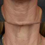 Best Clinic, Neck Skin Tightening, Sofwave Melbourne