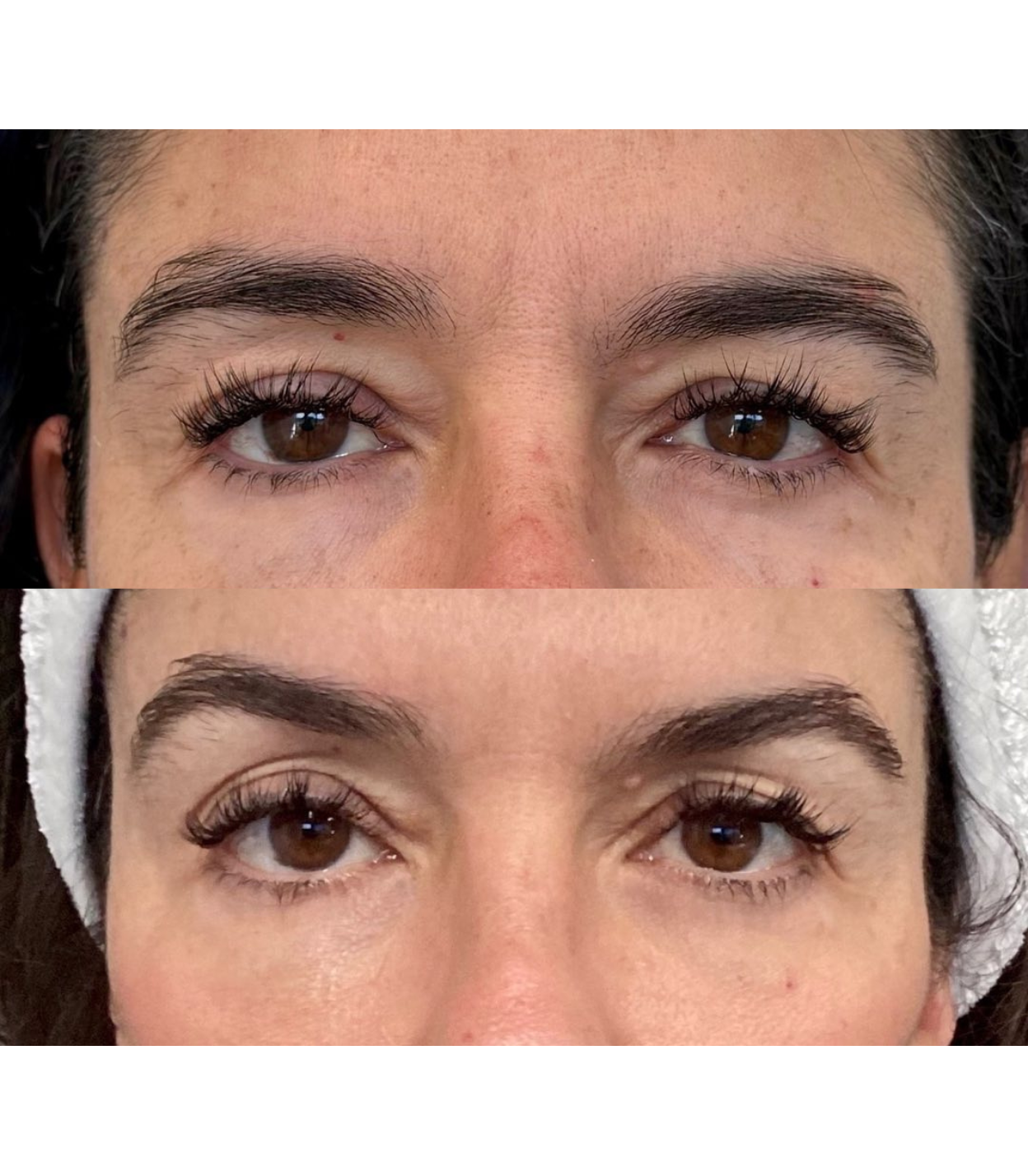 Best Clinic, Eye & Brow Lift, Sofwave Melbourne