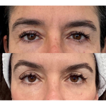 Best Clinic, Eye & Brow Lift, Sofwave Melbourne