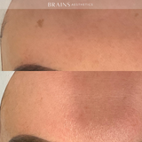 Even Tone Program – Dark Spots, Pigmentation & Uneven Tone