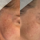 Even Tone Program – Dark Spots, Pigmentation & Uneven Tone
