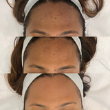 Even Tone Program – Dark Spots, Pigmentation & Uneven Tone