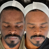 Even Tone Program – Dark Spots, Pigmentation & Uneven Tone