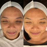 Even Tone Program – Dark Spots, Pigmentation & Uneven Tone