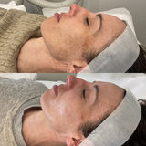 Even Tone Program – Dark Spots, Pigmentation & Uneven Tone