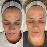 Even Tone Program – Dark Spots, Pigmentation & Uneven Tone