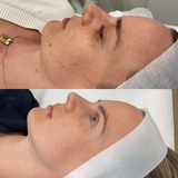 Even Tone Program – Dark Spots, Pigmentation & Uneven Tone