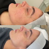 Even Tone Program – Dark Spots, Pigmentation & Uneven Tone