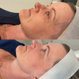 Even Tone Program – Dark Spots, Pigmentation & Uneven Tone